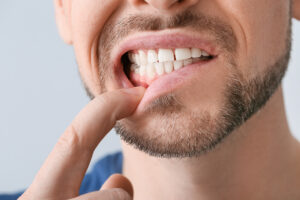 san diego gum disease symptoms