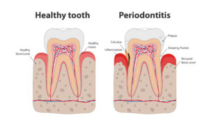 encinitas gum disease