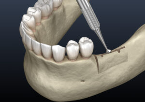 encinitas ridge augmentation