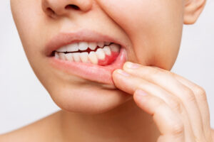 encinitas gum disease