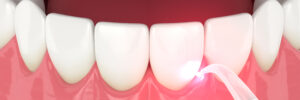 encinitas dental lasers
