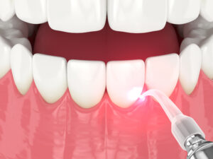 encinitas dental lasers