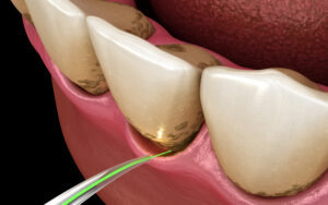 encinitas dental laser