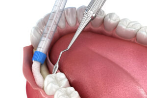 encinitas jawbone grafting