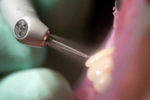 encinitas dental lasers