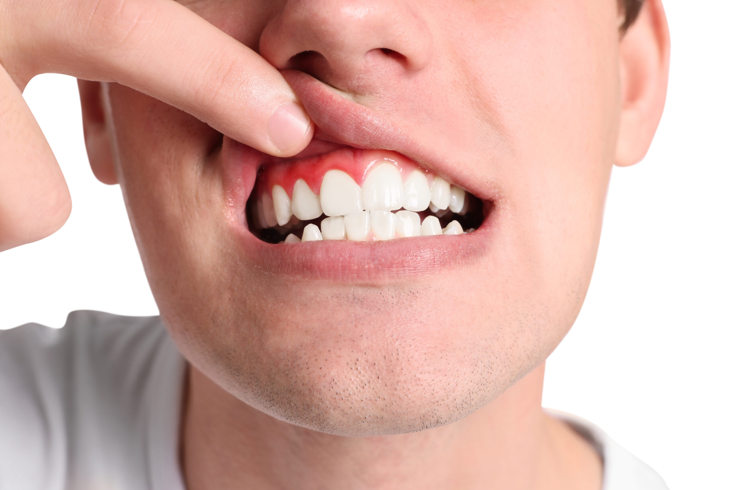 Treating Gum Recession With PST® Encinitas, CA