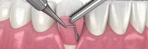 encinitas bone grafting