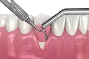 encinitas bone grafting