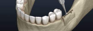 Encinitas jawbone grafting