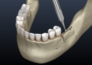 Encinitas jawbone grafting