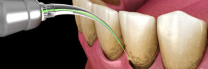 Encinitas dental lasers