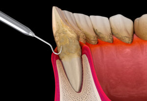 Oral hygiene: Scaling and root planing (conventional periodontal therapy). Medically accurate 3D illustration of human teeth treatment