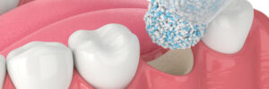encinitas laser grafting
