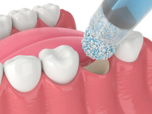 encinitas laser grafting