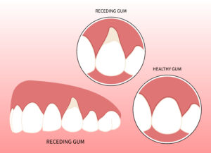 Encinitas gum grafts
