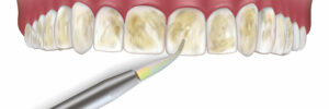 Encinitas dental lasers