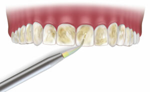 Encinitas dental lasers