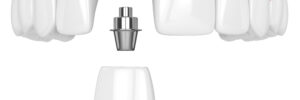 encinitas jawbone grafting