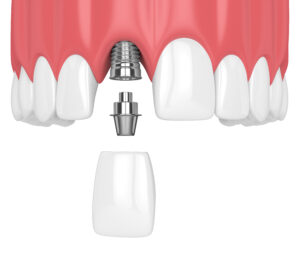 encinitas jawbone grafting