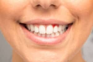 encinitas gum disease