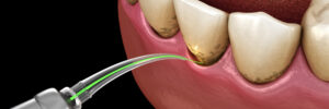 encinitas laser dentistry
