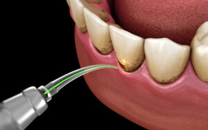 encinitas laser dentistry