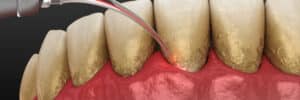 Encinitas dental lasers
