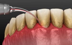 Encinitas dental lasers