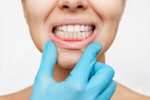 encinitas jawbone grafting