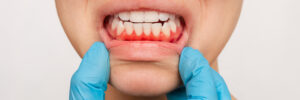 encinitas gum disease