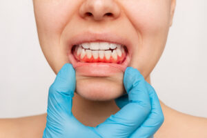 encinitas gum disease