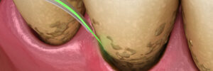Encinitas laser dental care