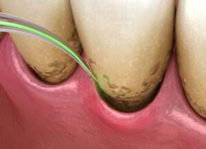 Encinitas laser dental care