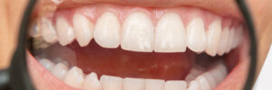 encinitas pinhole gum grafts