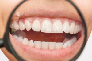 encinitas pinhole gum grafts