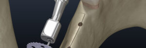 encinitas jawbone grafting