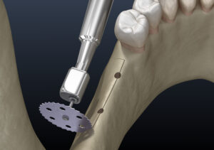 encinitas jawbone grafting