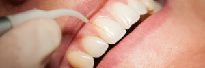 encinitas dental lasers