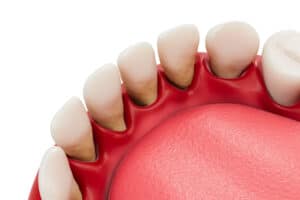 encinitas gum grafts