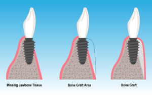 encinitas jawbone grafting