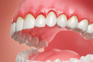 encinitas gum grafts