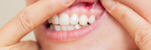 encinitas gum disease laser care