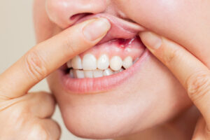 encinitas gum disease laser care
