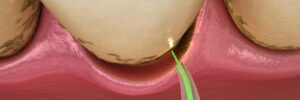 encinitas laser treatment