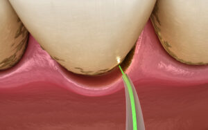 encinitas laser treatment