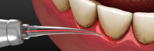 encinitas laser repair