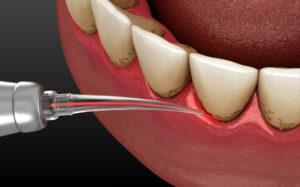 encinitas laser repair