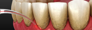 encinitas laser treatment