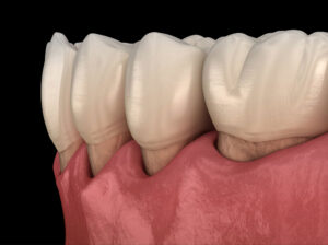 encinitas gum disease