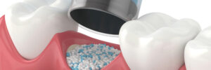 encinitas jawbone grafting